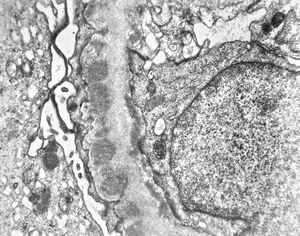 F,28y. | type III membranoproliferative glomerulonephritis